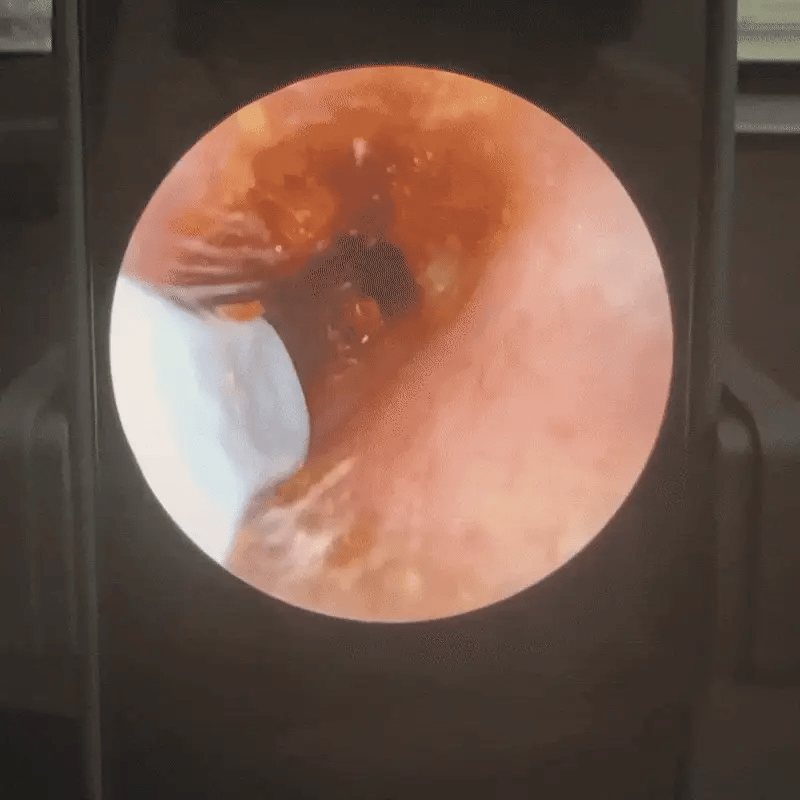 WaxOut – Earwax Removal Camera Tool